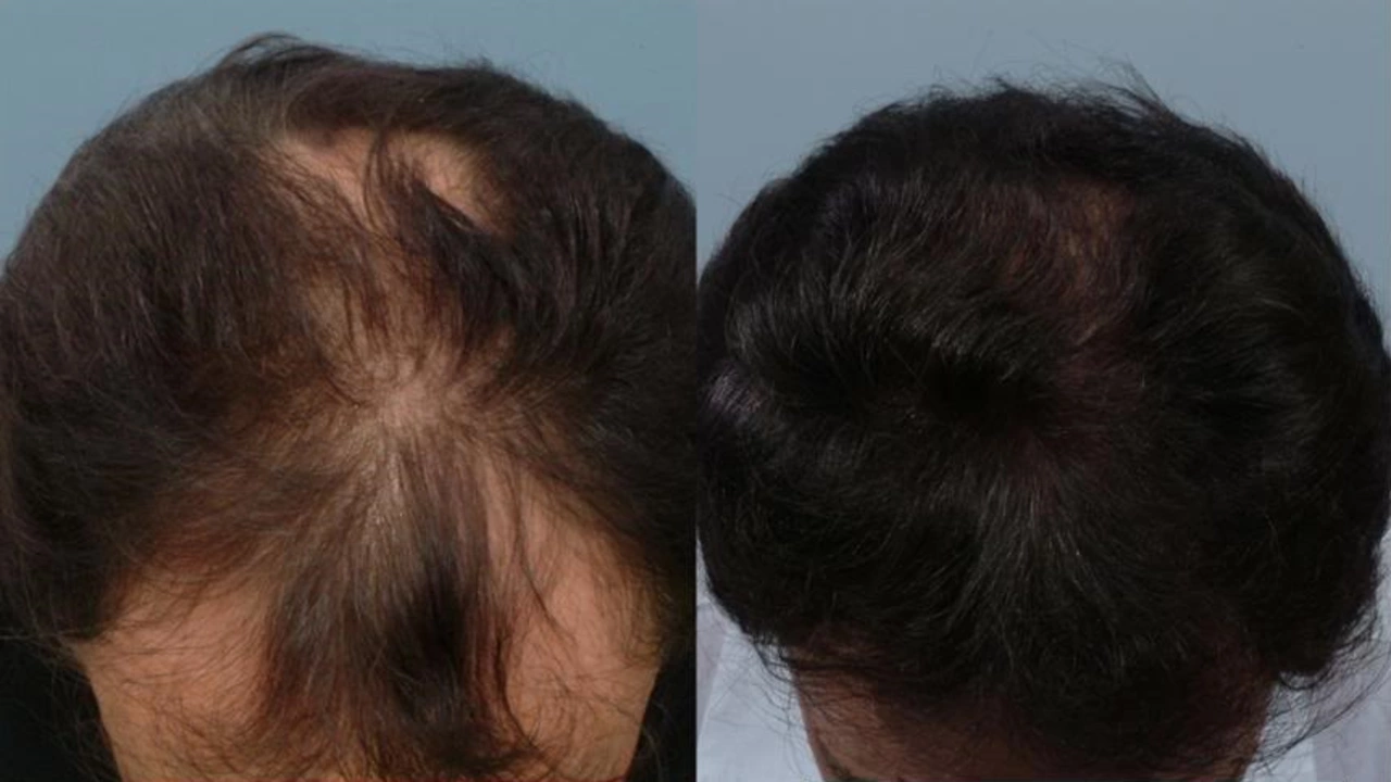 Venlafaxine and Hair Loss: A Possible Side Effect to Consider